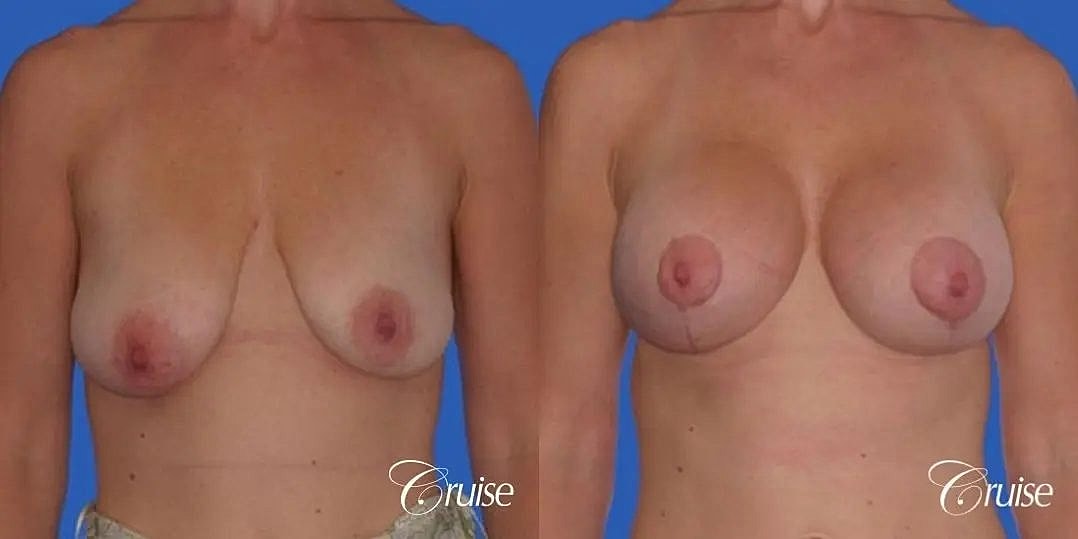 Breast Lift Augmentation Before & After