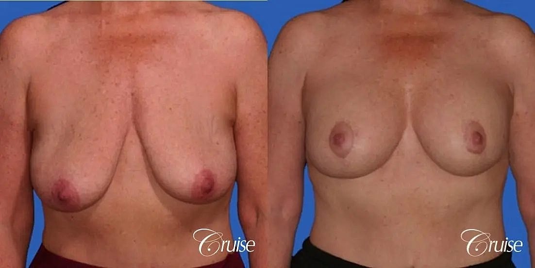 Breast Lift Augmentation Before & After