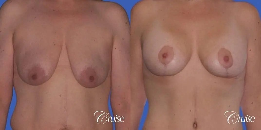 Breast Lift Augmentation Before & After