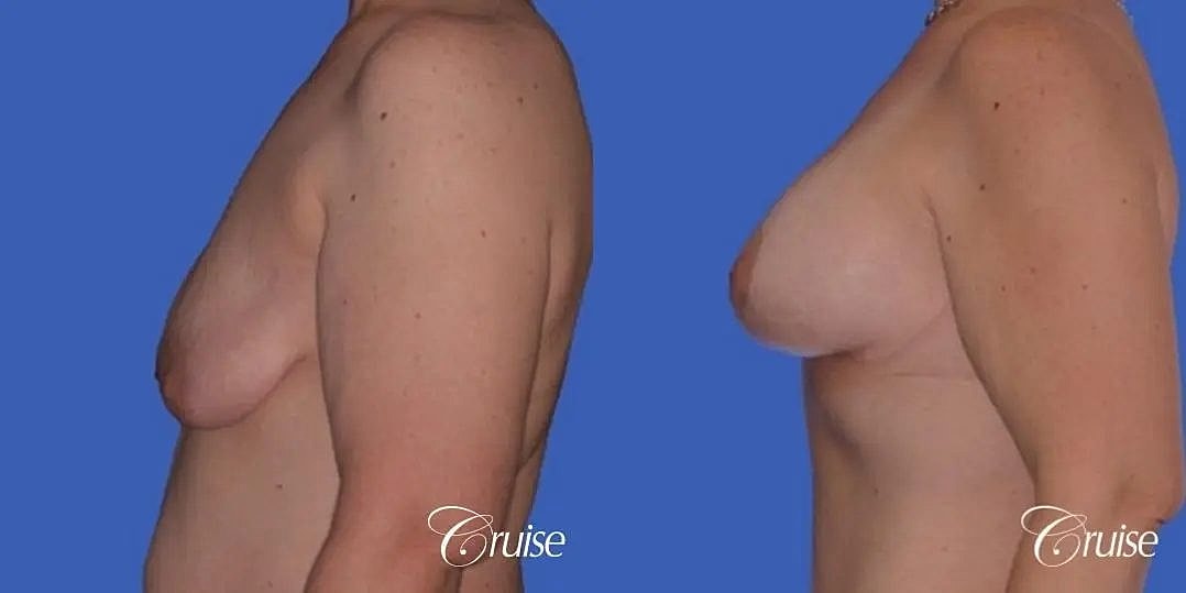 Breast Lift Augmentation Before & After