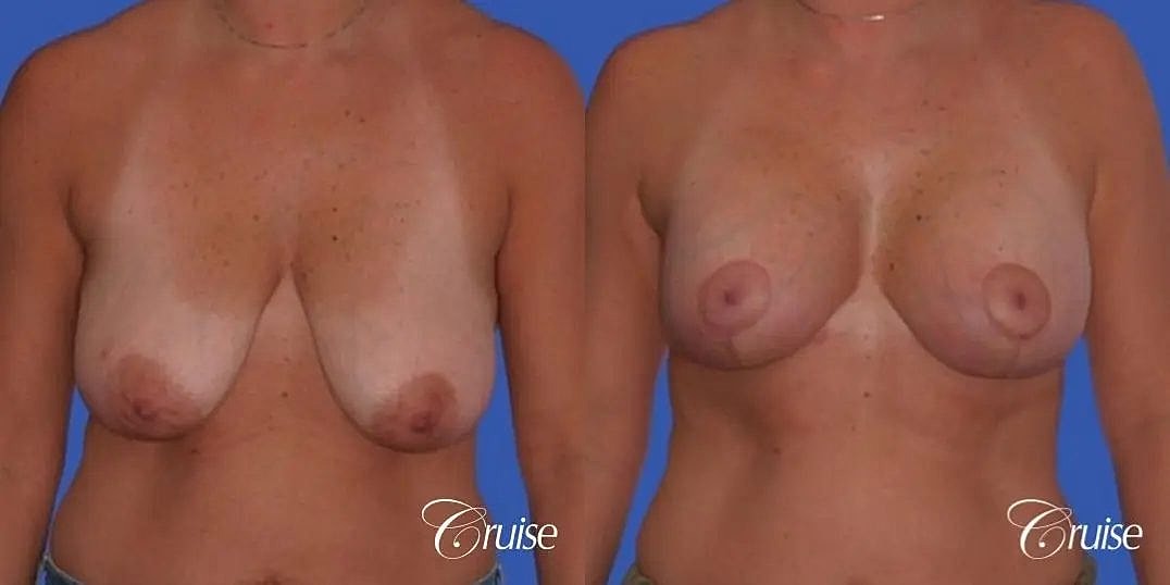 Breast Lift Augmentation Before & After