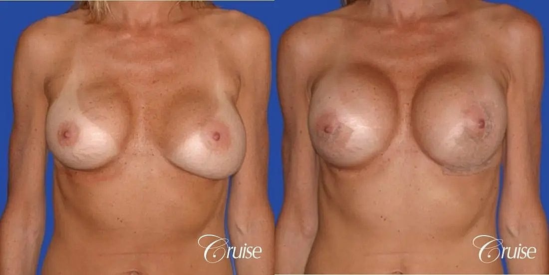 Breast Lift Augmentation Before & After