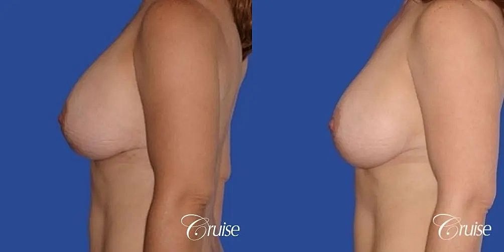 Breast Lift Augmentation Before & After