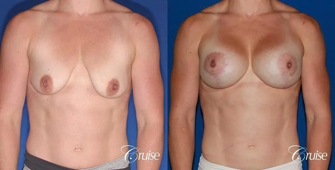 Breast Lift Augmentation Before & After