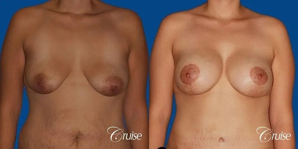 Breast Lift Augmentation Before & After
