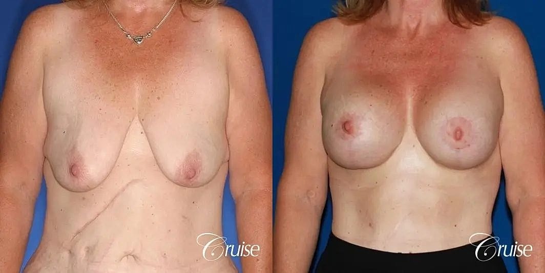 Breast Lift Augmentation Before & After
