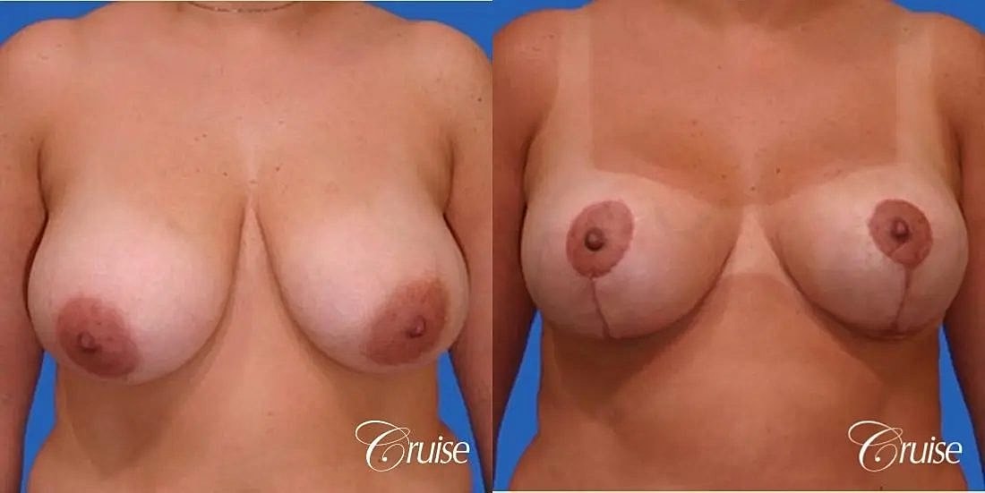 Breast Lift Augmentation Before & After