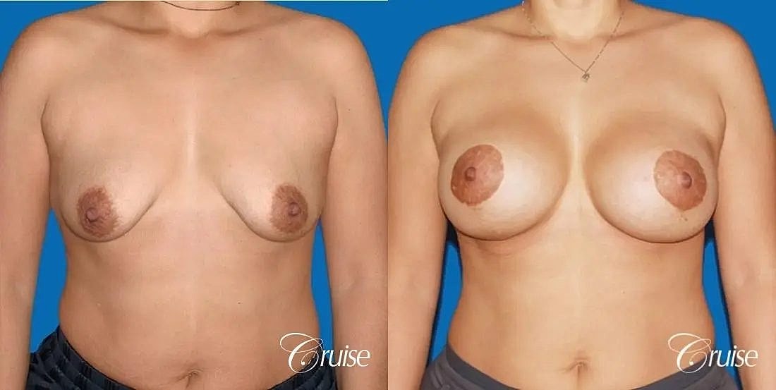 Breast Lift Augmentation Before & After