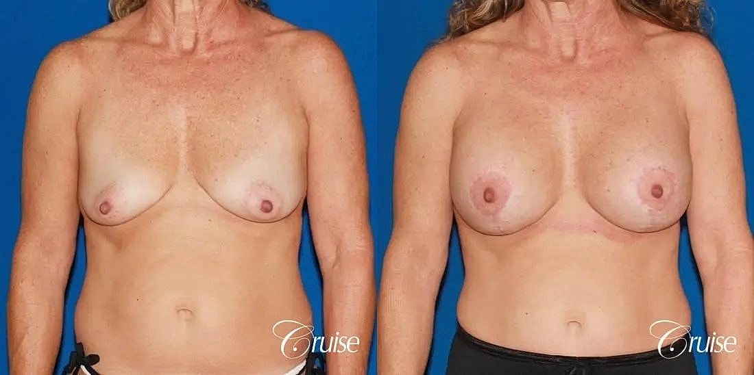 Breast Lift Augmentation Before & After