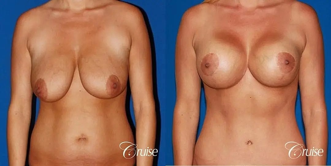 Breast Lift Augmentation Before & After