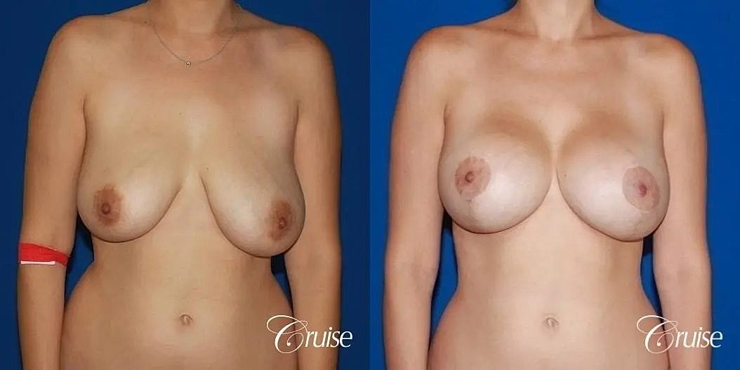 Breast Lift Augmentation Before & After