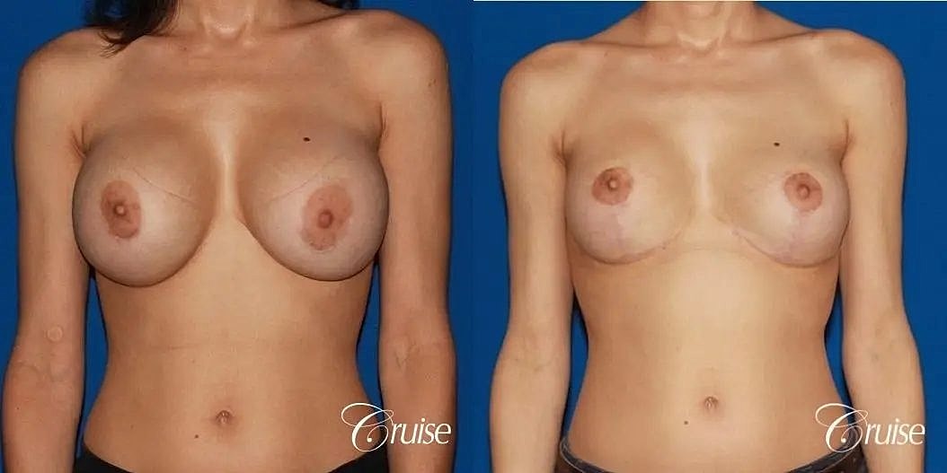 Breast Lift Augmentation Before & After