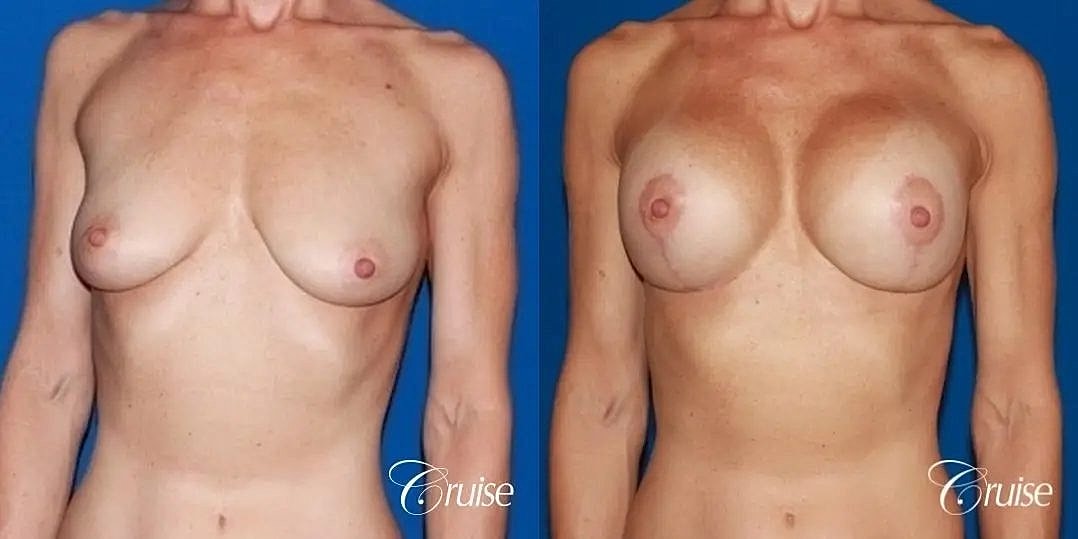 Breast Lift Augmentation Before & After