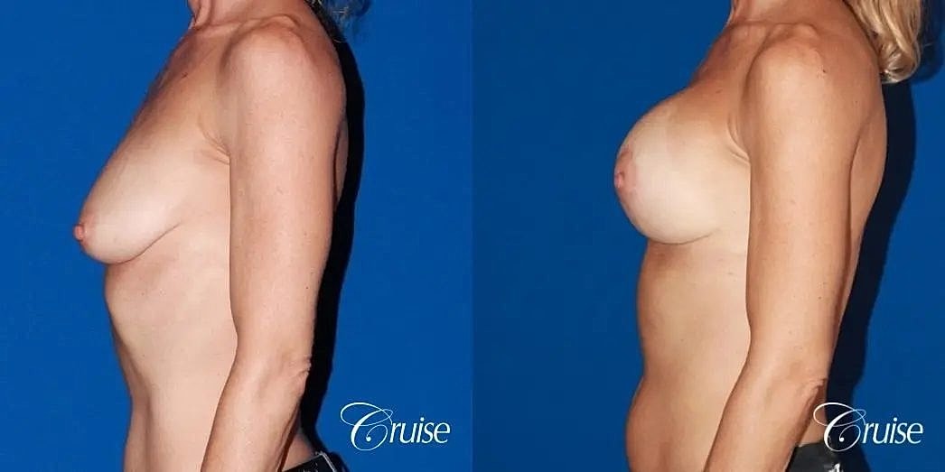 Breast Lift Augmentation Before & After