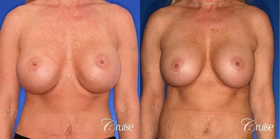 Breast Lift Augmentation Before & After
