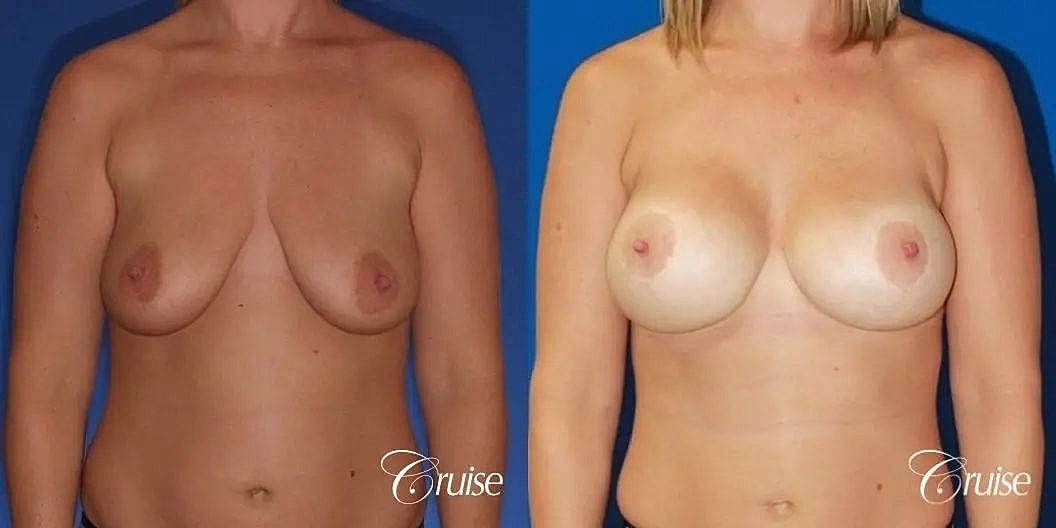 Breast Lift Augmentation Before & After