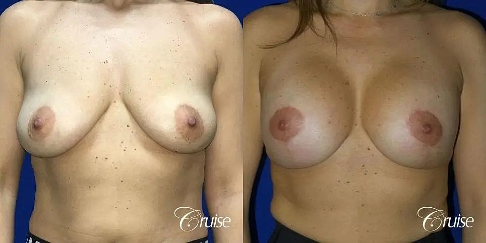 Breast Lift Augmentation Before & After