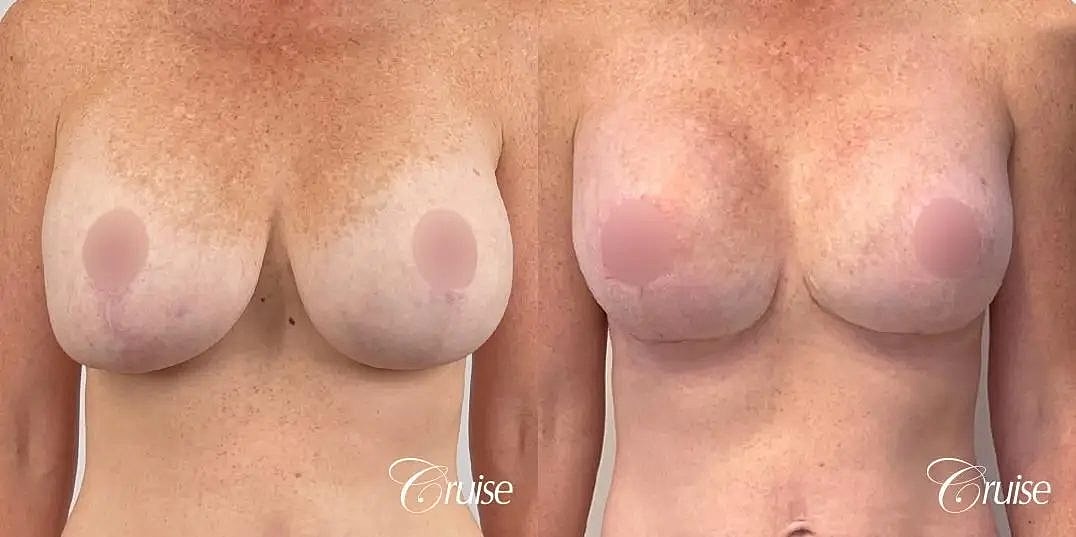 Breast Lift Augmentation Before & After