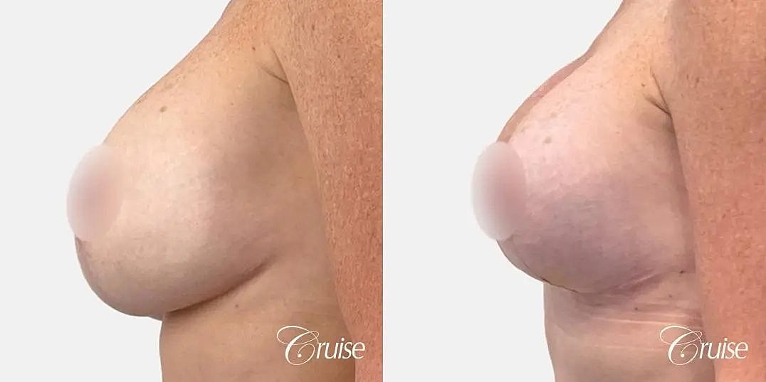 Breast Lift Augmentation Before & After