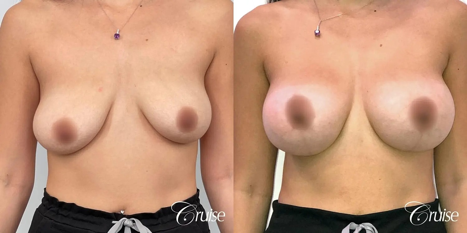 Breast Lift Augmentation Before & After