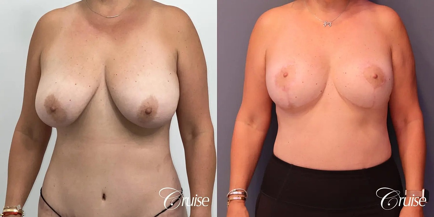 Breast Lift Augmentation Before & After