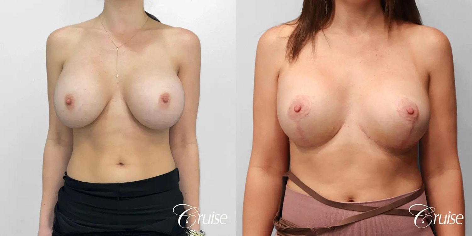 Breast Lift Augmentation Before & After