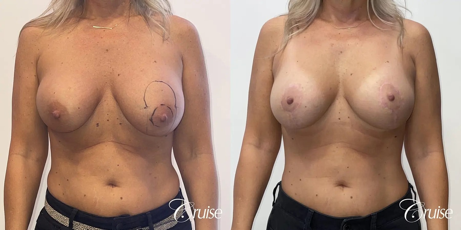 Breast Lift Augmentation Before & After