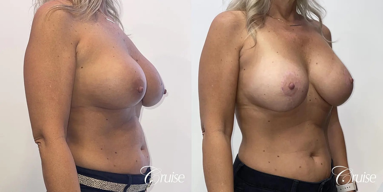 Breast Lift Augmentation Before & After
