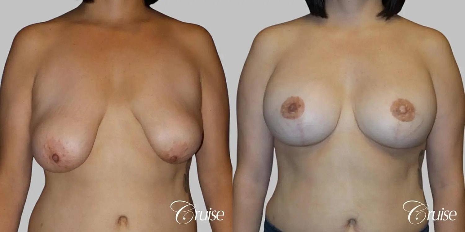 Breast Lift Augmentation Before & After