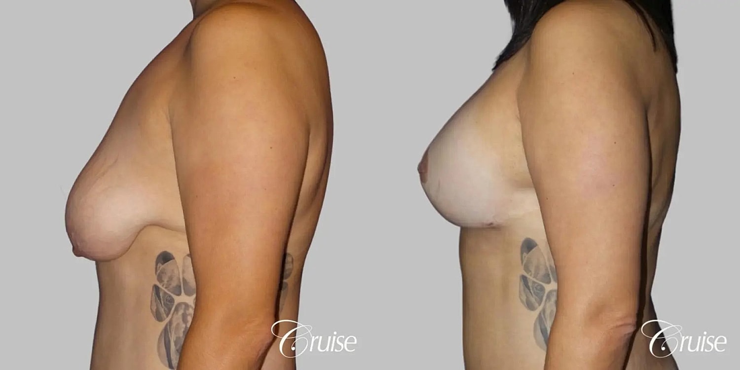 Breast Lift Augmentation Before & After