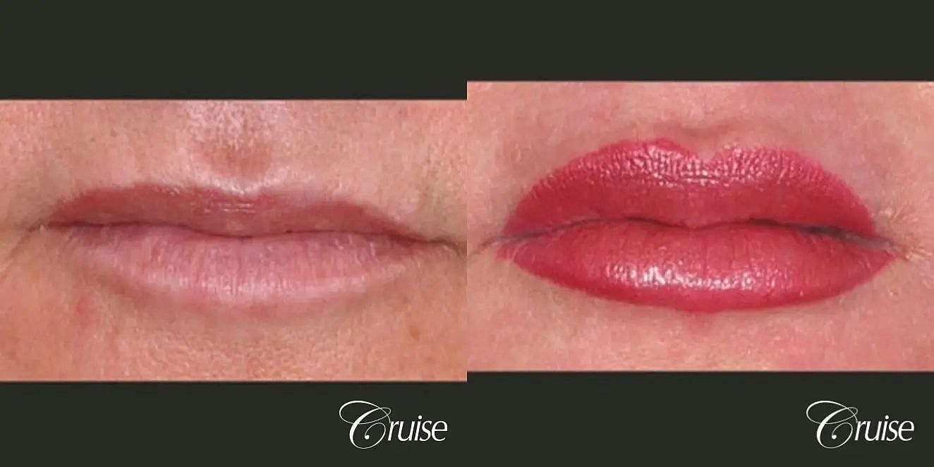 Lip Filler Before & After