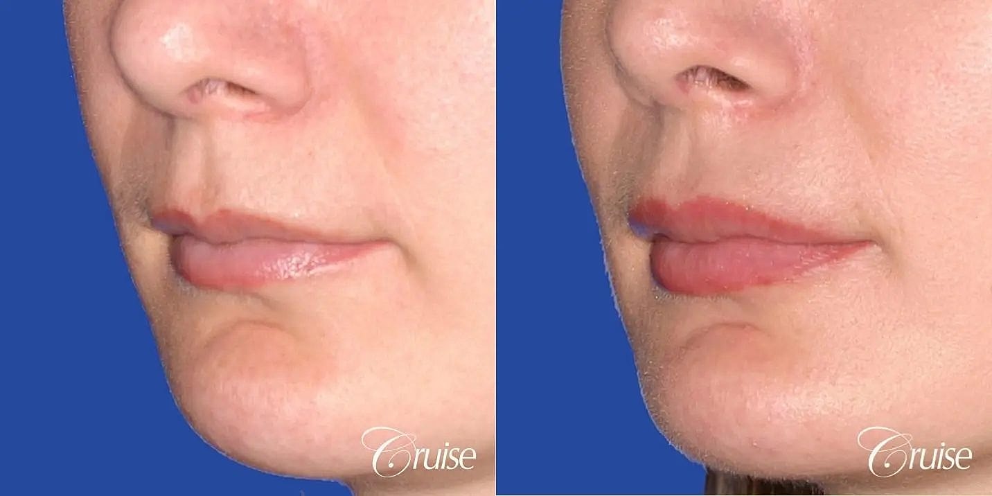 Lip Filler Before & After
