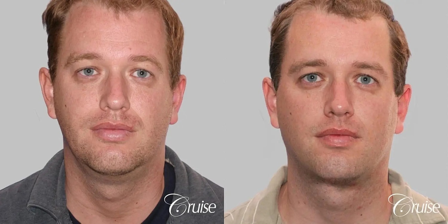 Neck Lift Before & After