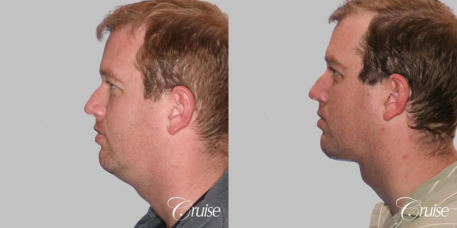 Neck Lift Before & After