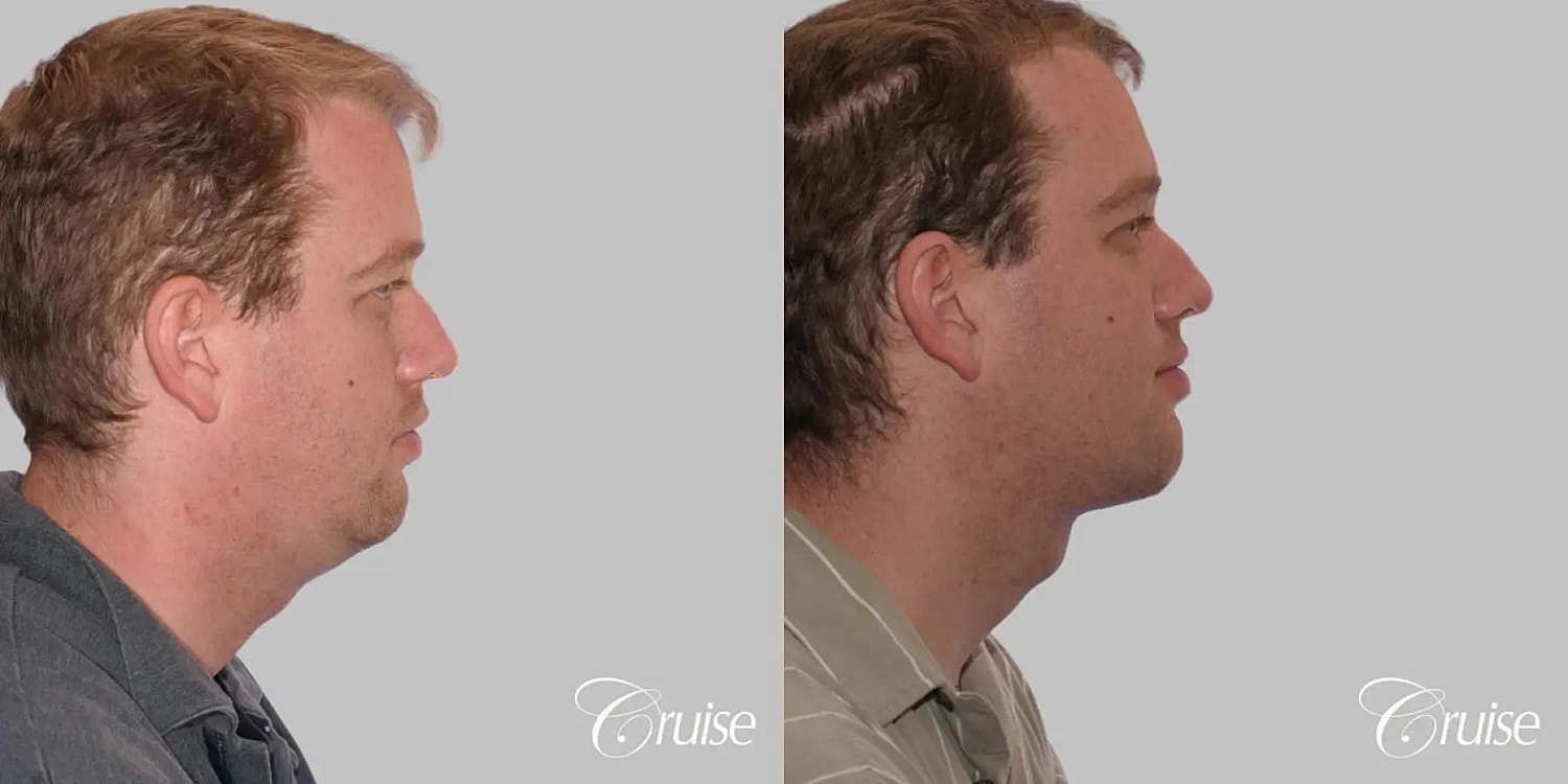 Neck Lift Before & After