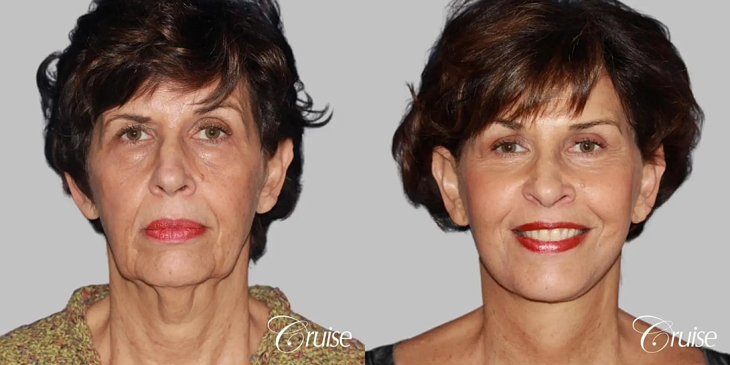 Neck Lift Before & After