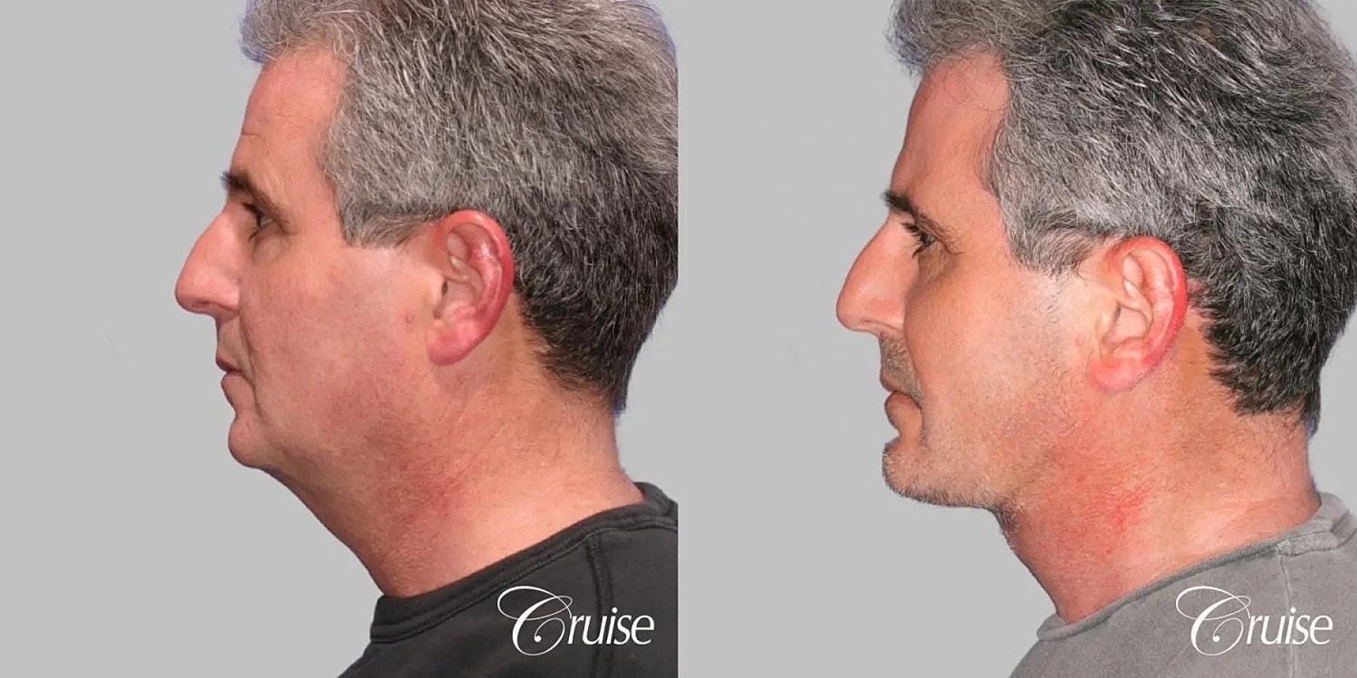 Neck Lift Before & After