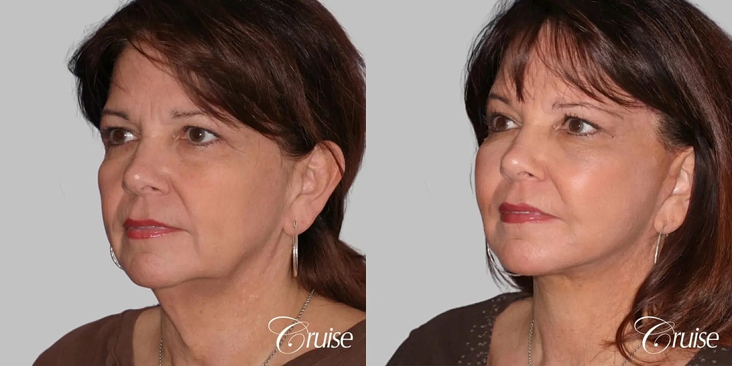 Neck Lift Before & After