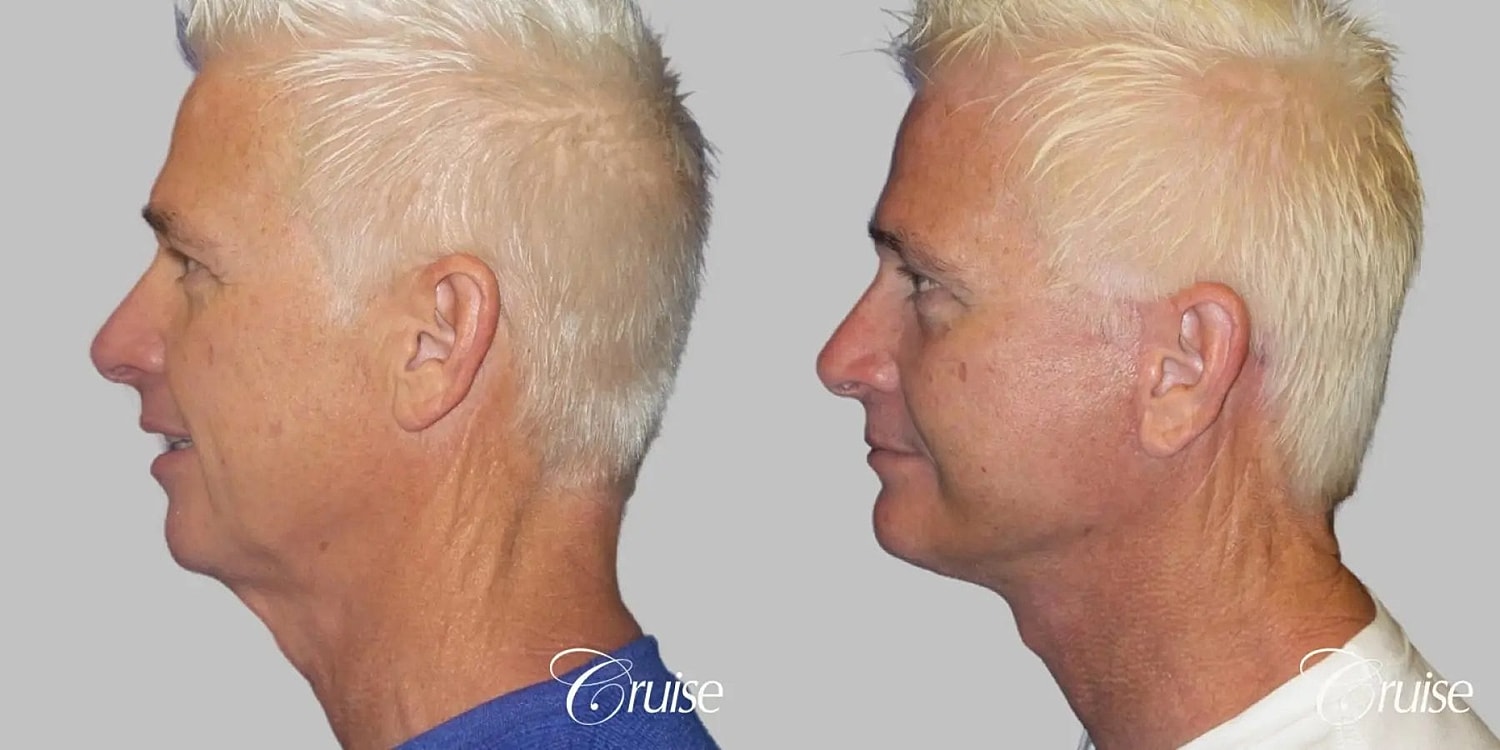 Neck Lift Before & After
