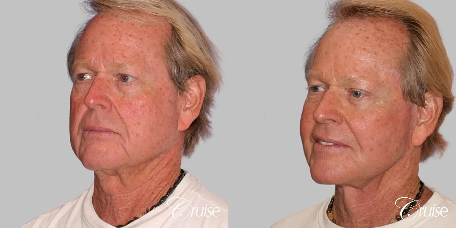 Neck Lift Before & After