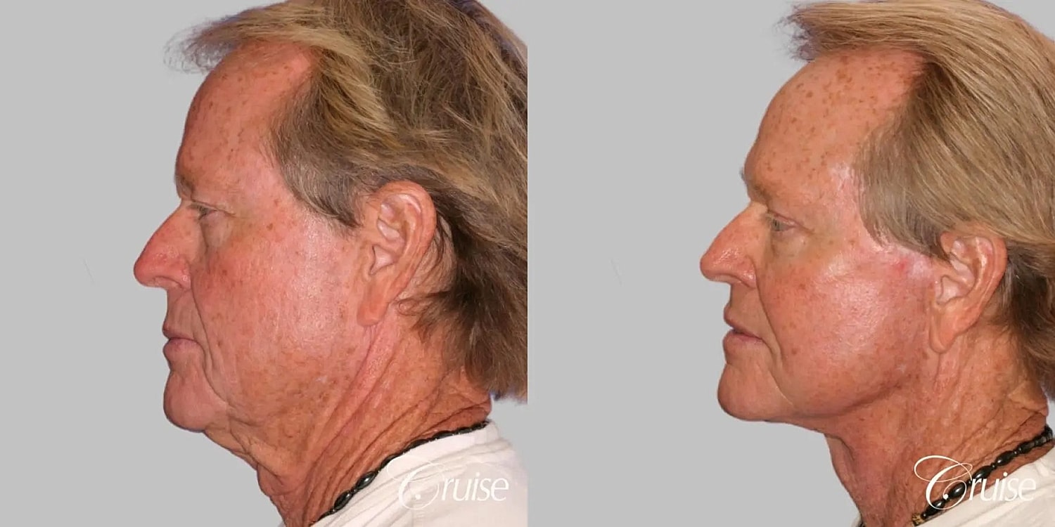 Neck Lift Before & After