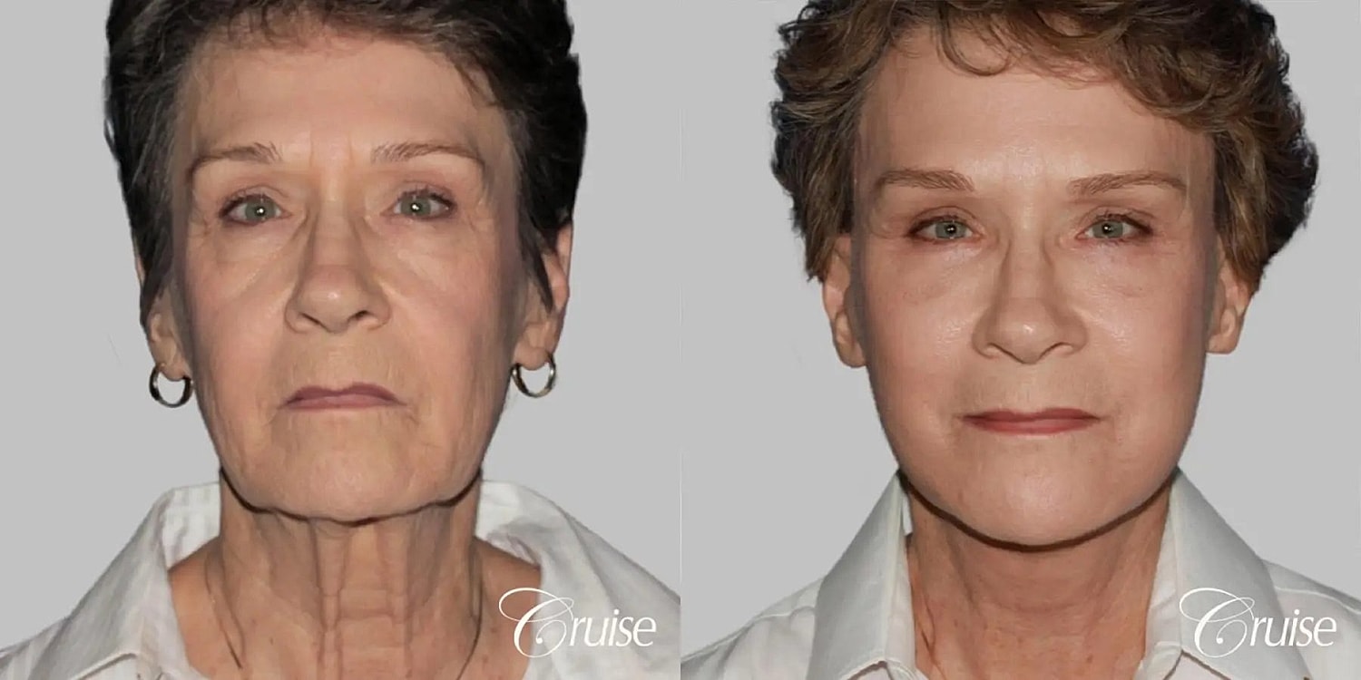 Neck Lift Before & After