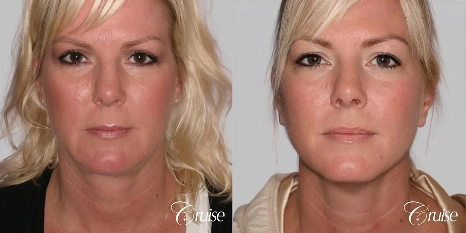 Neck Lift Before & After