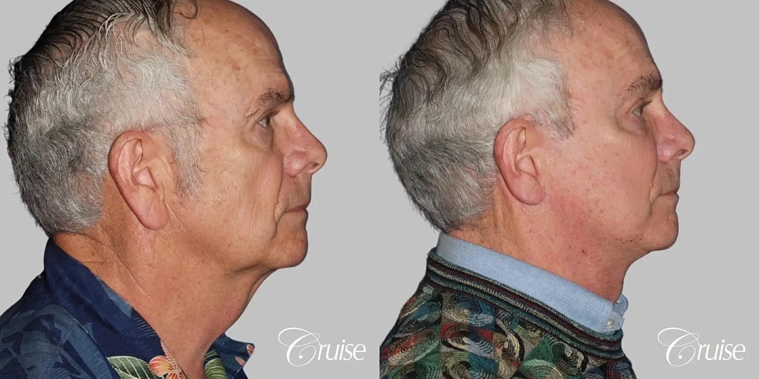 Neck Lift Before & After