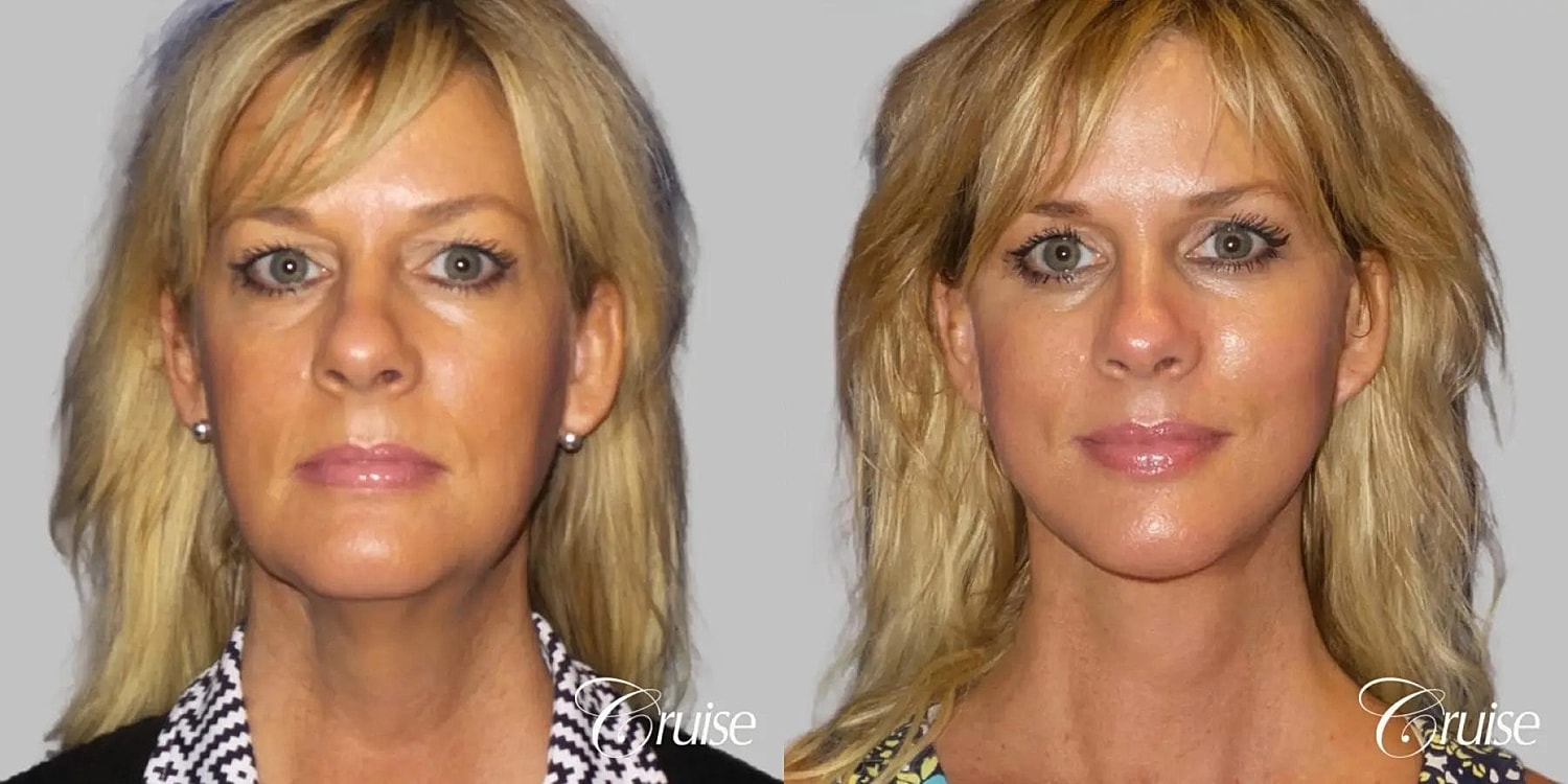 Neck Lift Before & After