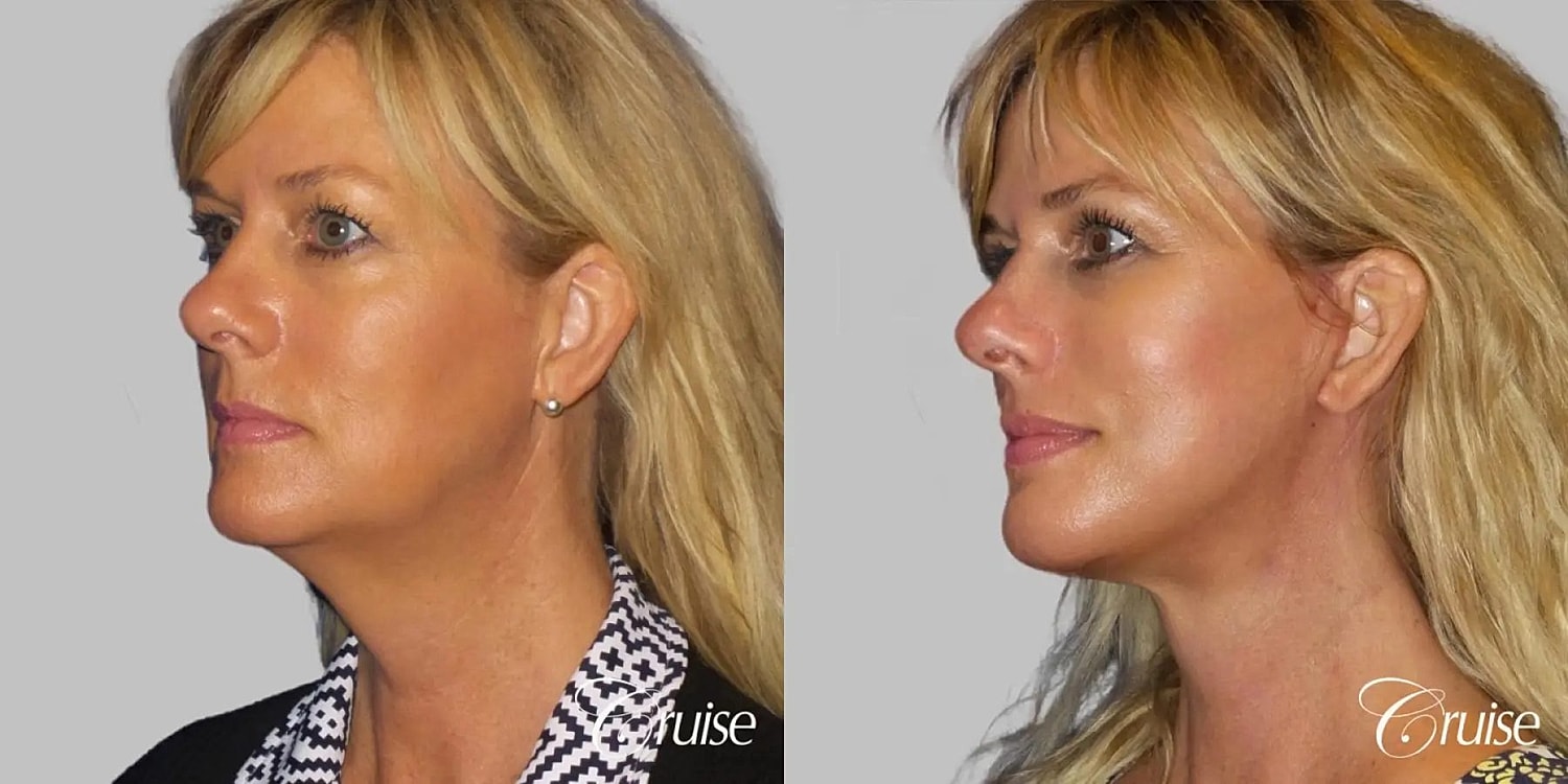 Neck Lift Before & After