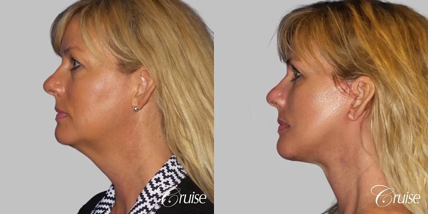 Neck Lift Before & After