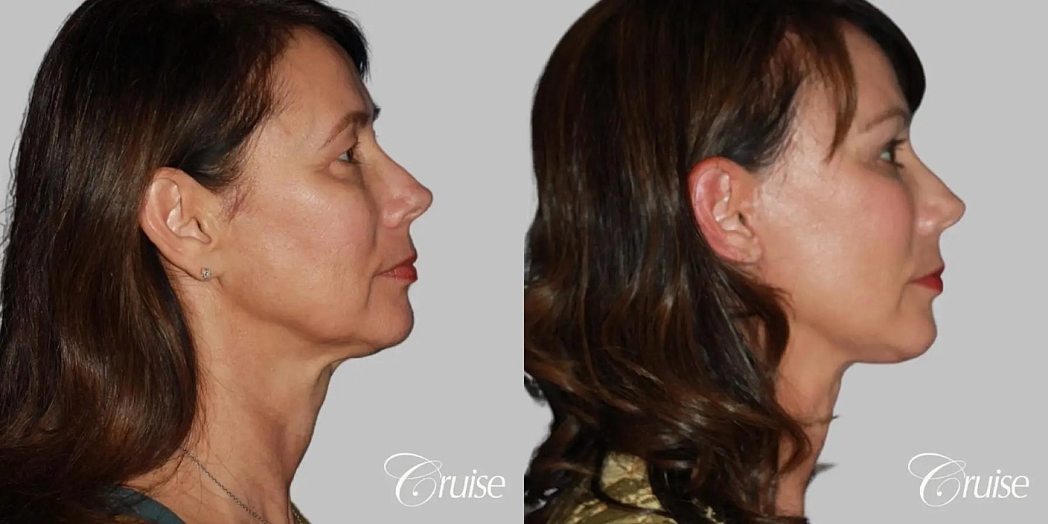 Neck Lift Before & After