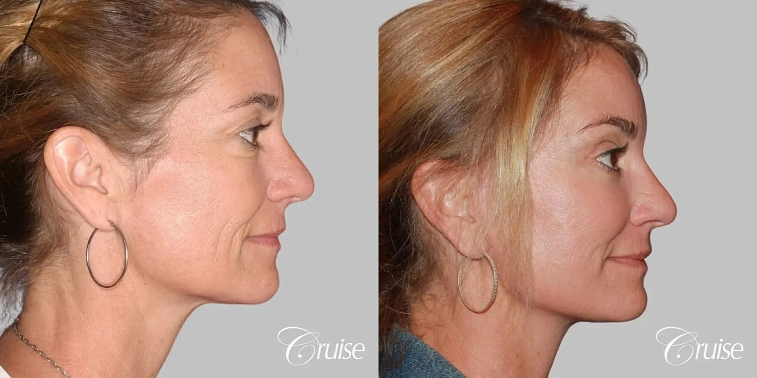 Neck Lift Before & After