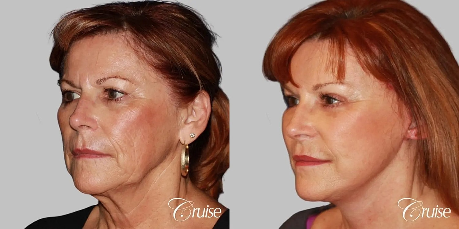 Neck Lift Before & After